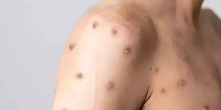 கொழும்பில் தட்டம்மை தீவிரம்: 52 நோயாளர்கள் அடையாளம்!