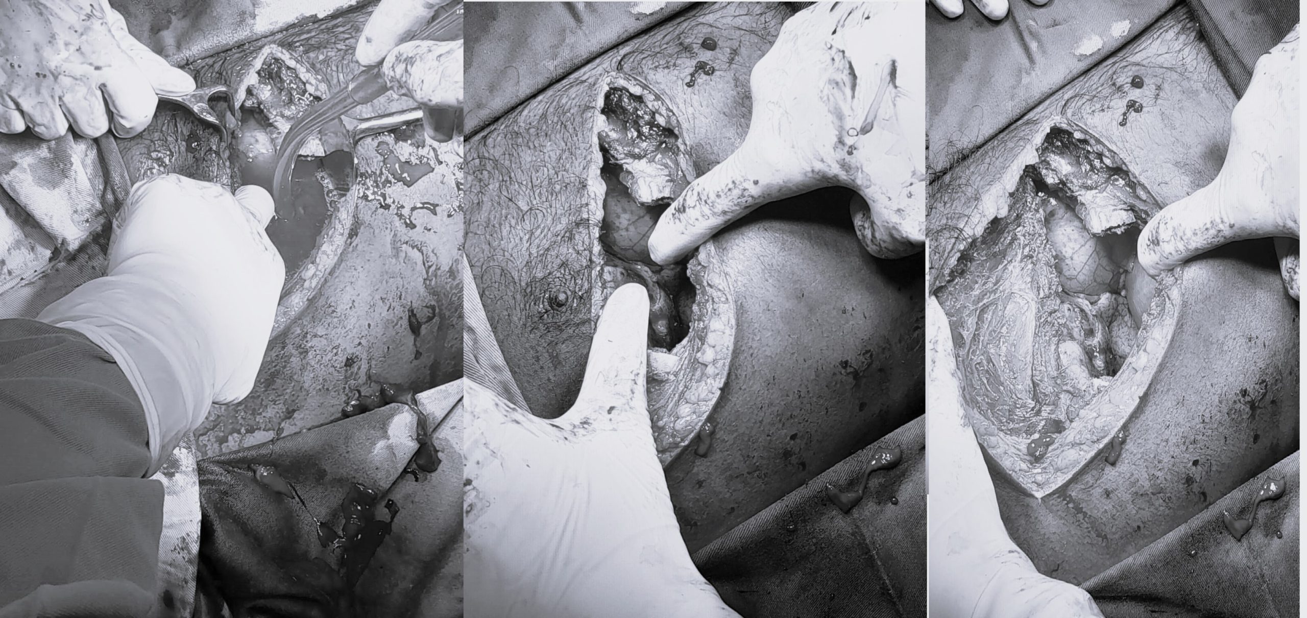 3 மணி நேர ‘நெஞ்சறை’ சத்திர சிகிச்சையில் உயிர் பிழைத்த இளைஞர் – மன்னார் வைத்தியசாலையில் சம்பவம் !